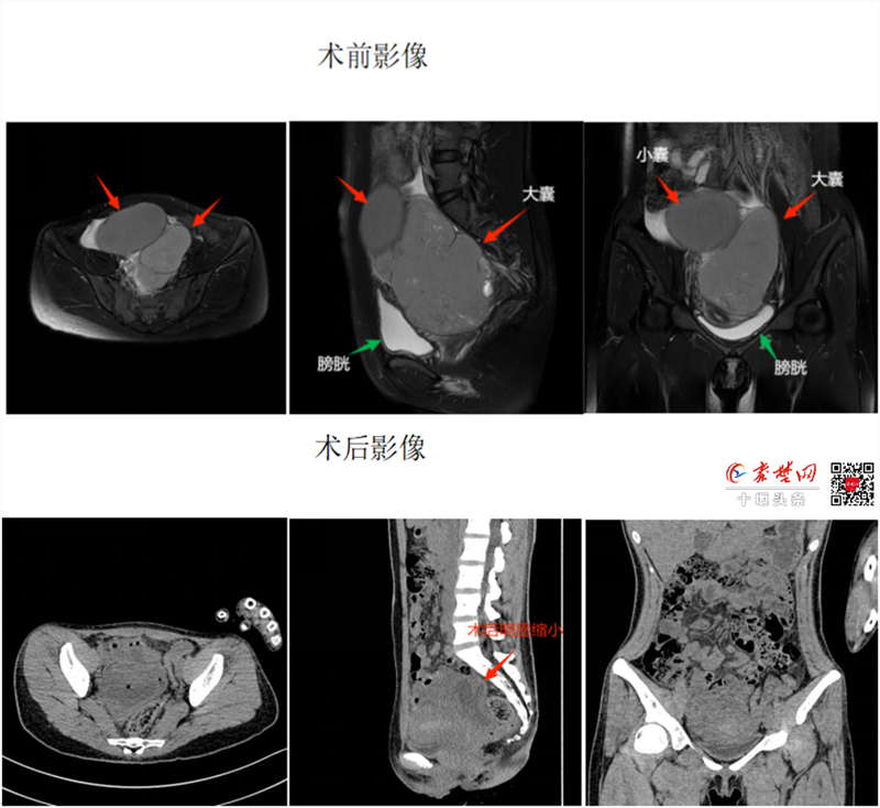 不開刀！十堰人醫一根“針”解決女性常見巧克力囊腫難題