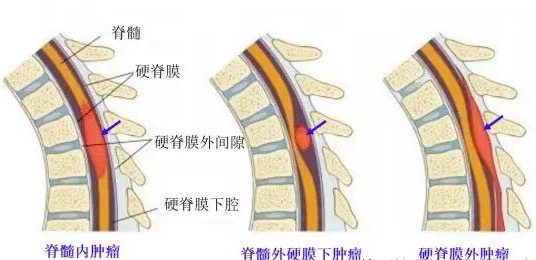 腰腿痛元兇：竟是椎管內腫瘤！十堰人醫精準除瘤阻截癱